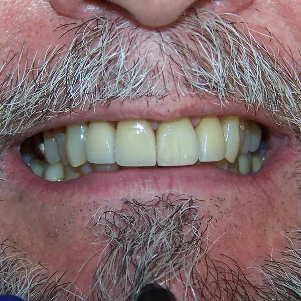 image of Anterior Veneers After