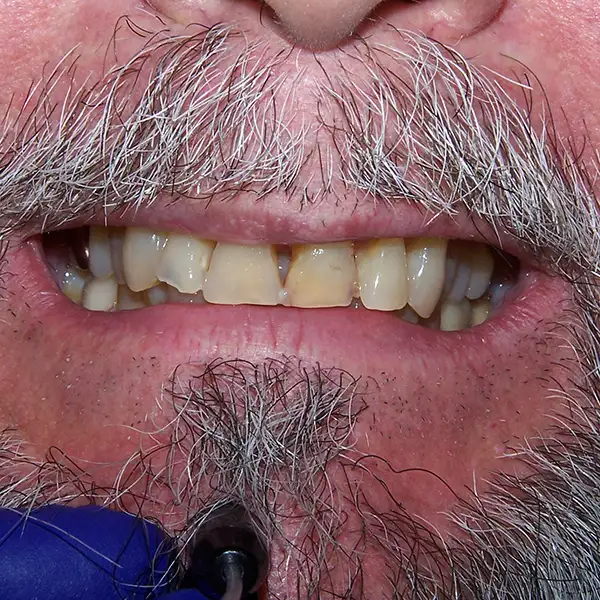 image of Anterior Veneers Before