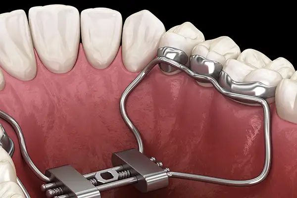 Rendering of orthodontic expanders