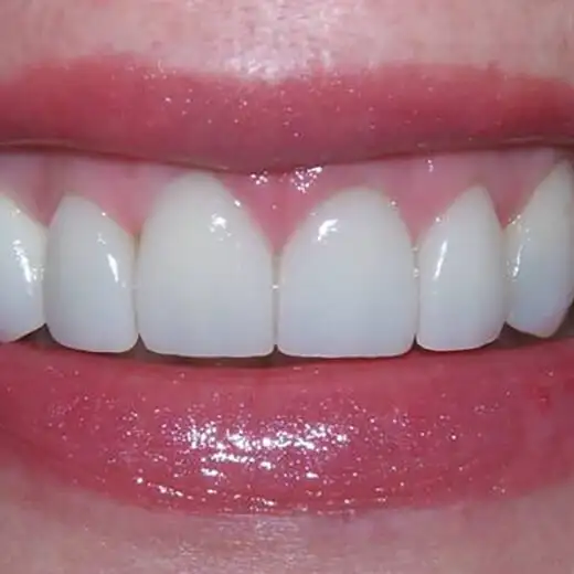 image of Patient Smile After 2