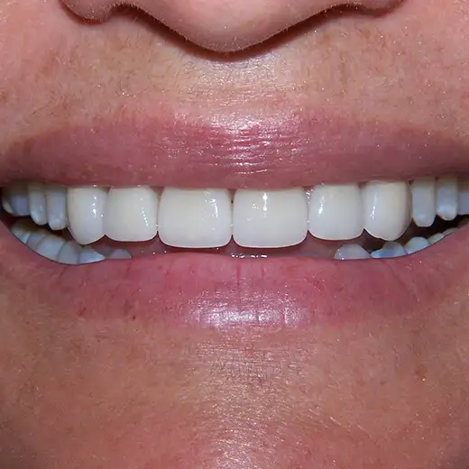 image of Patient Smile After 3