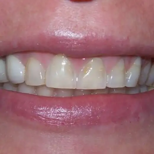 image of Patient Smile Before 2