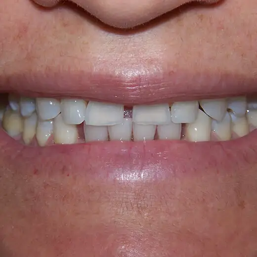 image of Patient Smile Before 3