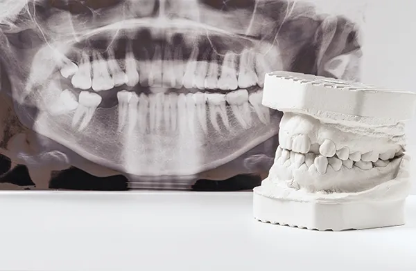 A plaster dental cast sitting next to a full x-ray of the jaw, both indicating the complications that arise from crooked and missing teeth.